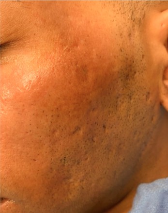 Narbenreduktion — Nachher