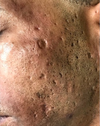 Narbenreduktion — Vorher