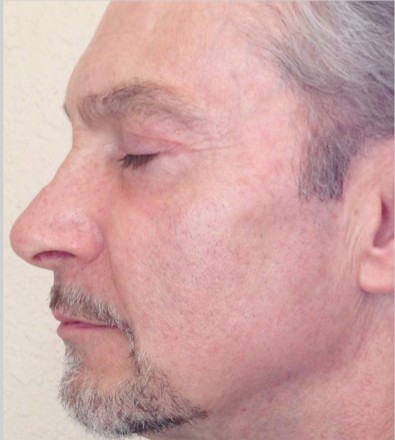 Pigmentreduktion — Nachher