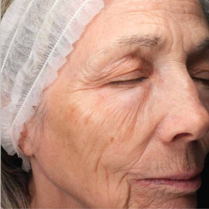 Hauterneuerung — Vorher