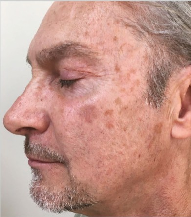 Pigmentreduktion — Vorher