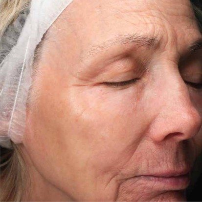 Hauterneuerung — Nachher