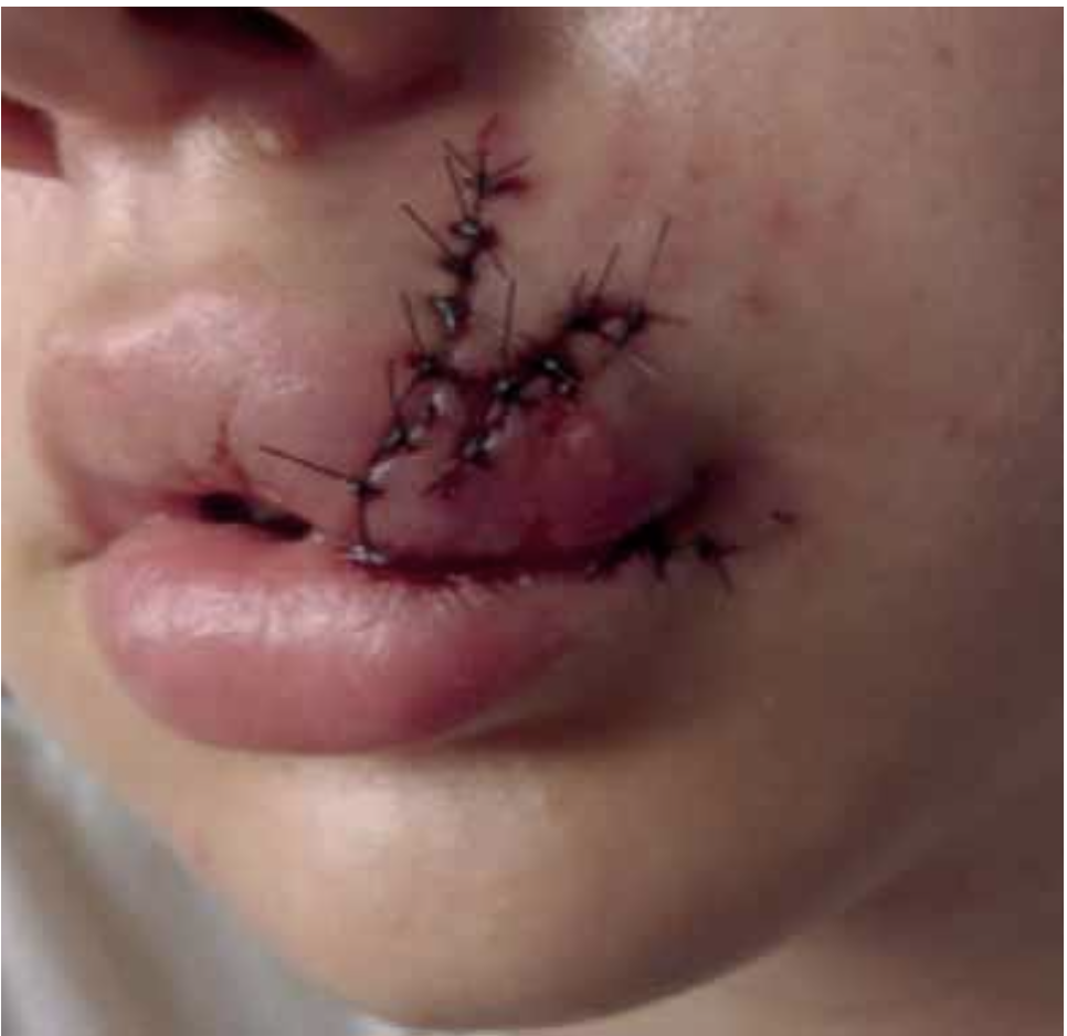 Lip scar — Vorher