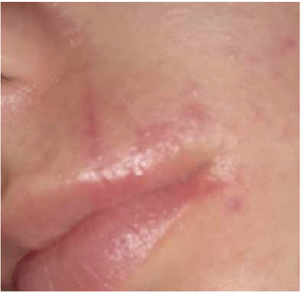 Lip scar — Nachher