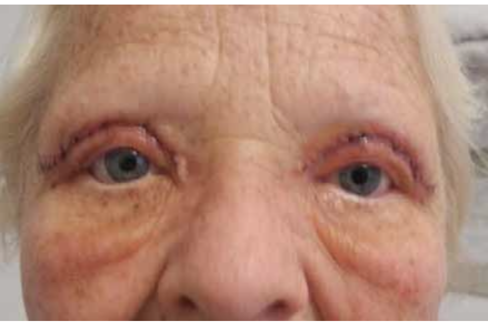 Post-blepharoplasty — Vorher