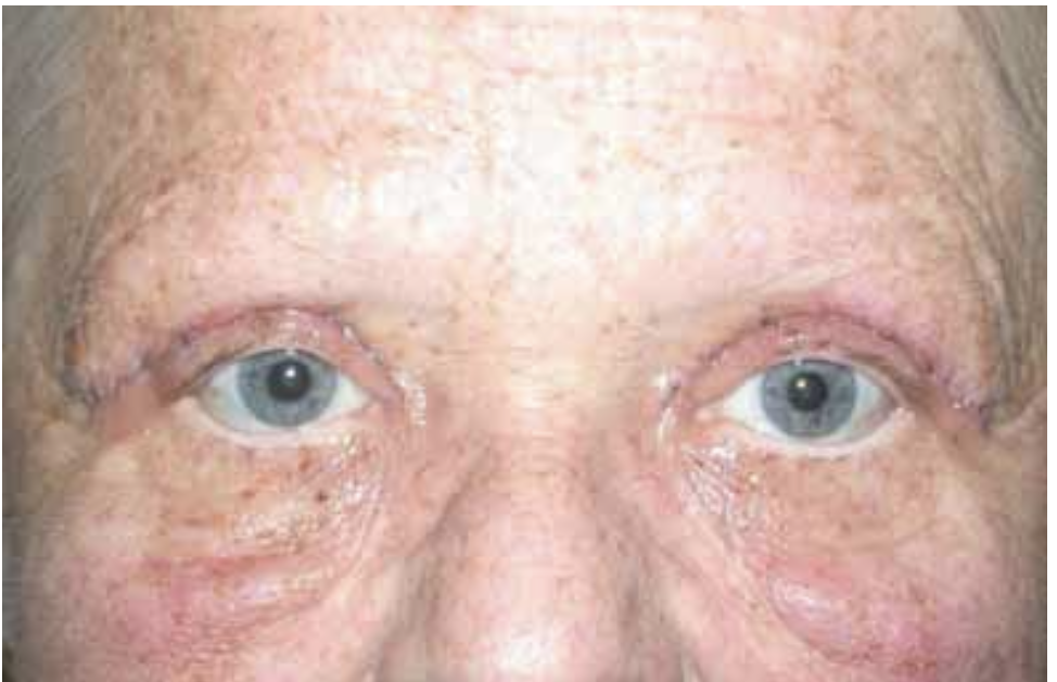 Post-blepharoplasty — Nachher