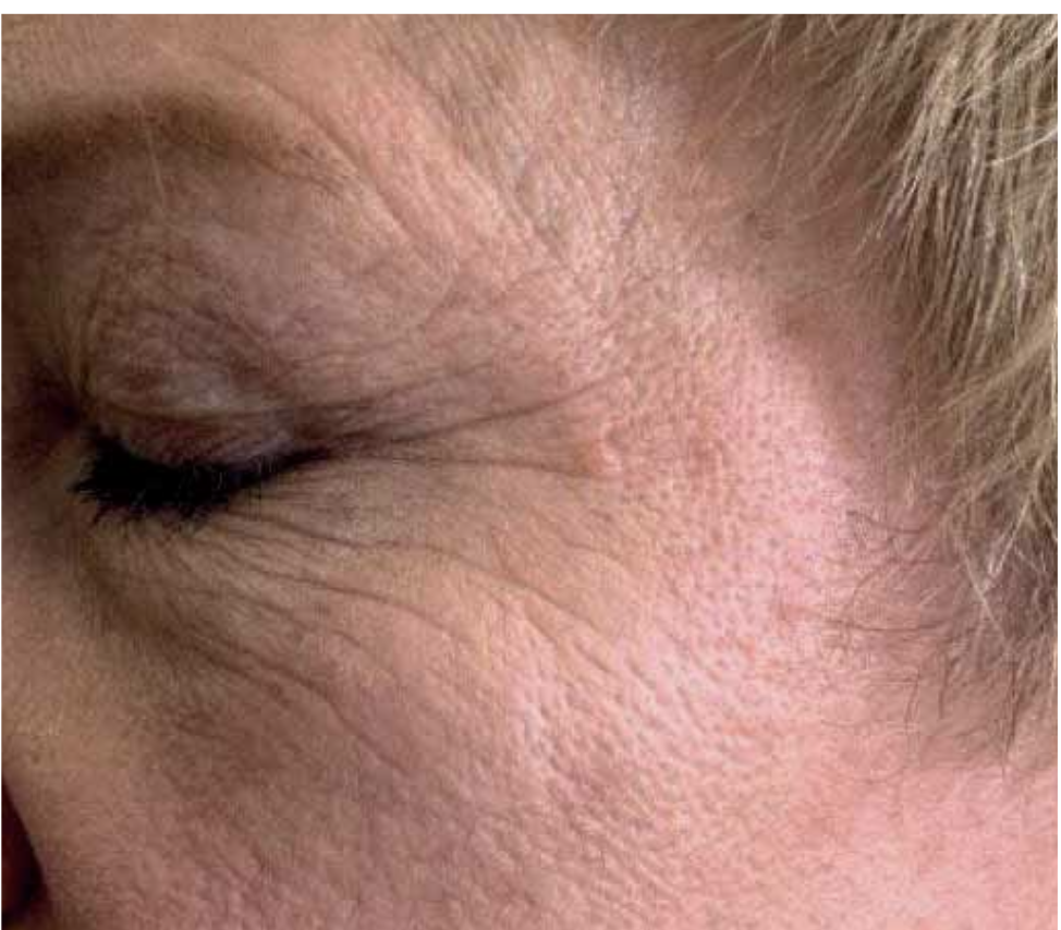 Wrinkle removal and facial oval firming — Vorher