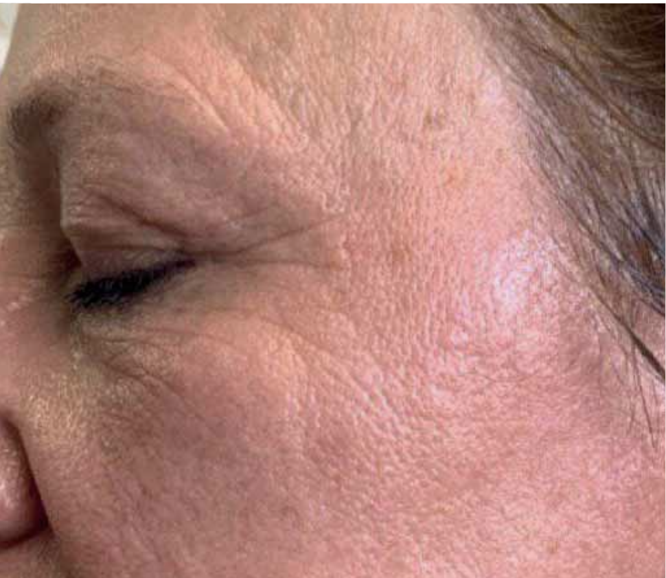Wrinkle removal and facial oval firming — Nachher