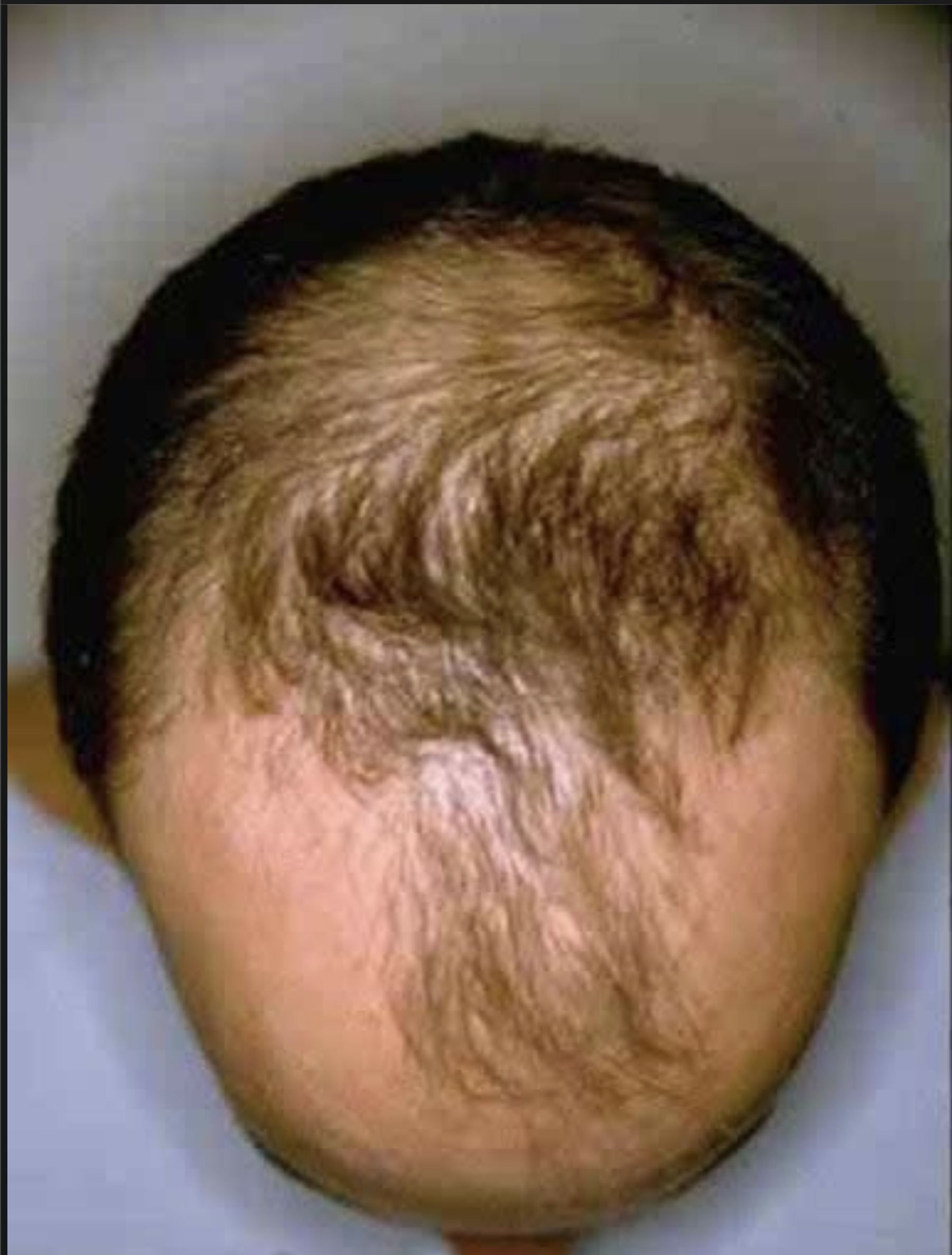 Narbenreduktion — Vorher