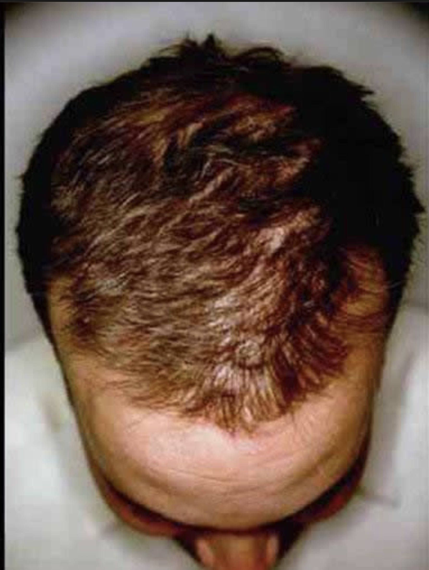 Narbenreduktion — Nachher